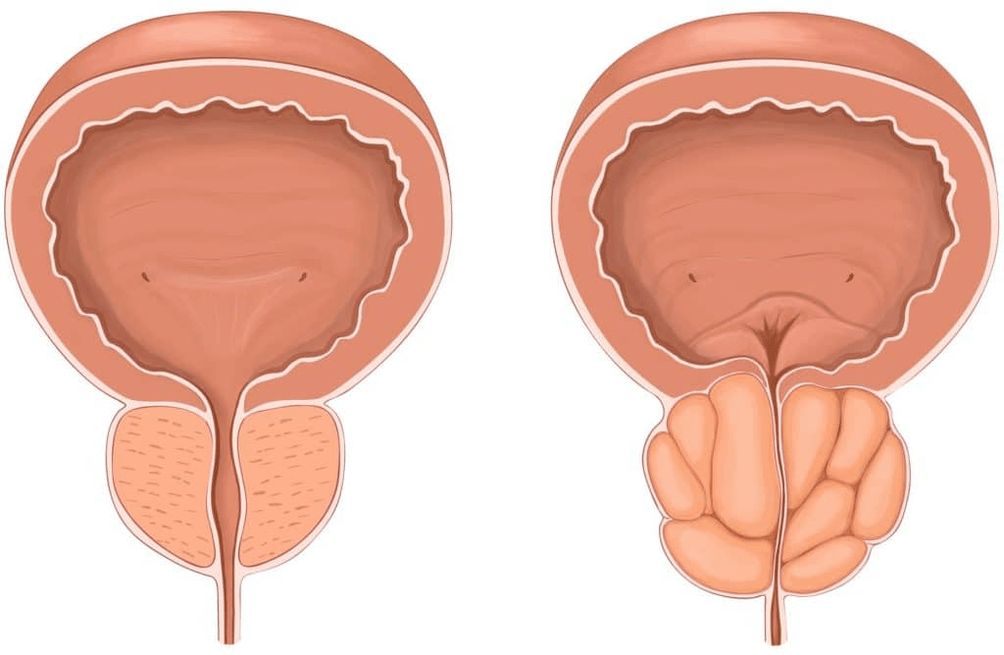 Que pasa coa próstata durante a prostatite