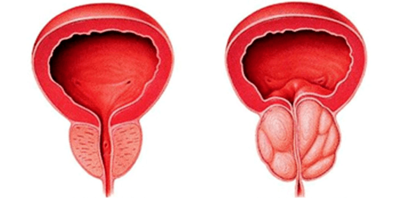 Glándula prostática normal e inflamada